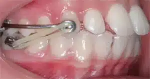 Teeth with carriere.