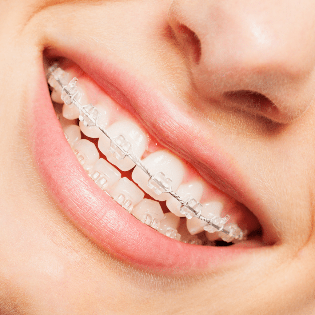 Smile with clear braces